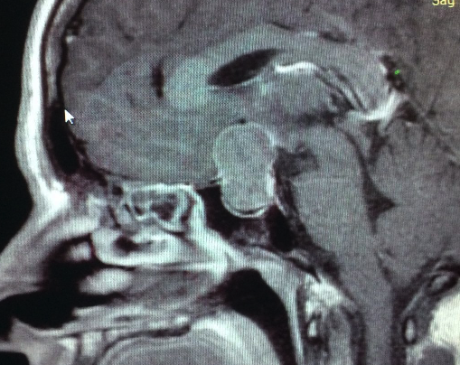 Adenomas Hipofisarios